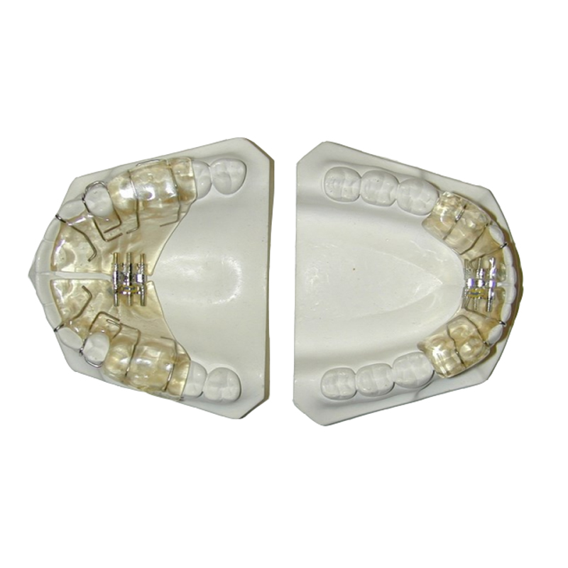 occlusal splint کے عمل کا طریقہ کار