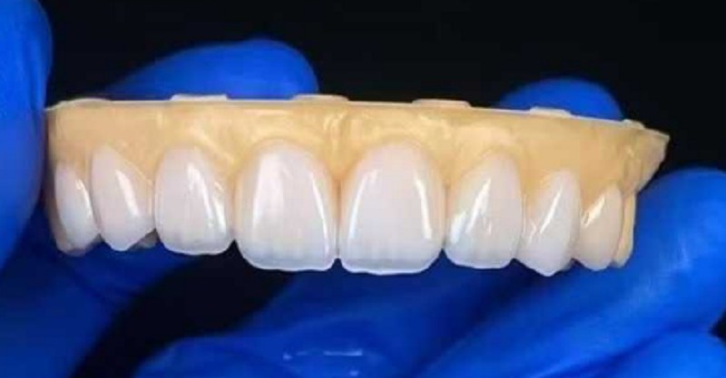 دانتوں کی ضرورت سے زیادہ دانتوں کے فرق کے مسئلے کی مرمت کے لئے دانتوں کی veneers