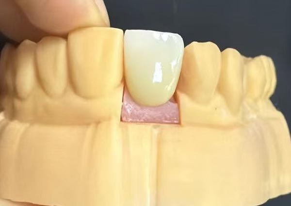 دانتوں کے مابین خلا کو ٹھیک کیا جاسکتا ہے - تیز دانت سب سے زیادہ پرکشش ہیں!