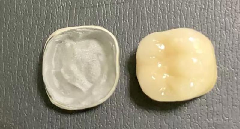 جب آپ کے چینی مٹی کے برتن تاج چپس ہوں تو کیا کریں؟ یہاں کیوں ہوتا ہے اور اسے ٹھیک کرنے کا طریقہ کیوں ہوتا ہے