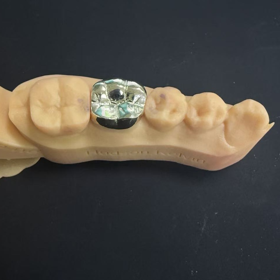 سونے کے تاج: زندگی بھر دانتوں کی بحالی کے لئے قیمتی دھات کا انتخاب