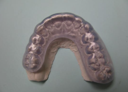 occlusal appliance