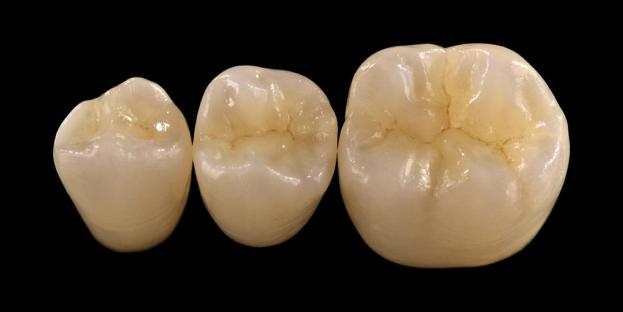 <h2>دندان سازی میں زرکونیا: اشارے، فوائد، اور طبی تحفظات</h2>
<p>Zirconia وسیع پیمانے پر اس کی طاقت اور استحکام کے لئے تسلیم کیا جاتا ہے. زرکونیا مواد کی تازہ ترین نسلیں نمایاں طور پر بہتر جمالیاتی خصوصیات بھی پیش کرتی ہیں۔ تمام سیرامک ​​بحالی پر غور کرنے والے مریضوں کے لیے، زرکونیا پر مبنی نظاموں کے اشارے اور حدود دونوں کا بغور جائزہ لینا ضروری ہے۔</p>
<p>آج کے مریض تیزی سے بحالی کی توقع کرتے ہیں جو مکمل فنکشنل کارکردگی کے ساتھ بہترین جمالیات کو یکجا کرتے ہیں۔ زیادہ تر جدید سیرامک ​​سسٹم ان توقعات کو پورا کر سکتے ہیں، لیکن طبی کامیابی کا زیادہ تر انحصار مناسب مواد کے انتخاب، دانتوں کی تیاری، اور سیمنٹیشن پروٹوکول پر ہوتا ہے۔ انتخاب کی رہنمائی اہم مادی خصوصیات جیسے فریکچر مزاحمت، لچکدار طاقت، پہننے کی مزاحمت، اور طویل مدتی استحکام سے ہونی چاہیے۔ ان مواد میں، زرکونیا عصری بحالی دندان سازی میں سب سے زیادہ استعمال ہونے والے اختیارات میں سے ایک بن گیا ہے۔</p>
<h3>Zirconia کیوں منتخب کریں؟</h3>
<p>Zirconia اس کی غیر معمولی طاقت اور طویل مدتی استحکام کے لئے قابل قدر ہے۔ جدید زرکونیا پچھلی نسلوں سے نمایاں طور پر مختلف ہے، جو زیادہ مبہم اور کم جمالیاتی تھیں۔ آج، CAD/CAM ٹکنالوجی بہتر نظری خصوصیات کے ساتھ زرکونیا کی بحالی کی درست ساخت کو قابل بناتی ہے۔</p>
<p>بحالی کو اس طرح ڈیزائن کیا جا سکتا ہے:</p>
<ul>
<li><strong>یک سنگی زرکونیا:</strong>پچھلے تاجوں اور پلوں کے لیے مثالی، اعلی طاقت اور استحکام پیش کرتے ہیں۔</li>
<li><strong>پرتوں والا زرکونیا:</strong>ایسے معاملات کے لیے موزوں ہے جن میں بہتر جمالیات کی ضرورت ہوتی ہے، بشمول منہ کے مختلف علاقوں میں طویل مدتی بحالی۔</li>
</ul>
<p>لچکدار طاقت قسم کے لحاظ سے مختلف ہوتی ہے، جس میں اعلی پارباسی زرکونیا میں تقریباً 590 MPa سے لے کر یک سنگی شکلوں میں 1400 MPa تک ہوتا ہے۔ زرکونیا کی بحالی کو خود چپکنے والی رال سیمنٹ یا رال میں ترمیم شدہ شیشے کے آئنومر سیمنٹ کا استعمال کرتے ہوئے سیمنٹ کیا جا سکتا ہے۔</p>
<h3>زرکونیا مواد کے انتخاب میں کلیدی عوامل</h3>
<p>تمام سیرامک ​​بحالی کے لیے زرکونیا پر غور کرتے وقت، معالجین کو کئی اہم عوامل کا جائزہ لینا چاہیے:</p>
<ul>
<li>باقی دانتوں کا ڈھانچہ</li>
<li>زبانی گہا میں مقام (جمالیاتی زون بمقابلہ فنکشنل زون)</li>
<li>برکسزم جیسی غیر فعال عادات کی موجودگی</li>
<li>ملحقہ قدرتی دانتوں کی شفافیت</li>
<li>دانتوں کی بنیادی ساخت کا رنگ اور حالت</li>
</ul>
<p>جمالیاتی زون میں عام طور پر پچھلے دانت شامل ہوتے ہیں، حالانکہ کچھ مریضوں میں یہ مسکراہٹ کی لکیر اور چہرے کی حرکیات کے لحاظ سے پہلے داڑھ تک پھیل سکتا ہے۔ فنکشنل زون میں عام طور پر پریمولرز اور داڑھ شامل ہوتے ہیں، جہاں مخفی قوتیں نمایاں طور پر زیادہ ہوتی ہیں۔</p>
<h3>فنکشنل زون ایپلی کیشنز</h3>
<p>پچھلے علاقوں میں، occlusal قوتوں پر احتیاط سے غور کیا جانا چاہیے۔ Zirconia روایتی PFM بحالی کا ایک بہترین متبادل ہے، خاص طور پر ایسے معاملات میں جہاں بحالی کی جگہ محدود ہے۔ جدید یک سنگی زرکونیا اعلی طاقت کو برقرار رکھتے ہوئے، فنکشنل cusps اور مارجنل ریجز سمیت، occlusal anatomy کے مکمل کنٹور ڈیزائن کی اجازت دیتا ہے۔</p>
<p>موجودہ شواہد سے پتہ چلتا ہے کہ یک سنگی زرکونیا فریکچر اور پہننے کے خلاف بہترین مزاحمت کی وجہ سے پچھلے تاجوں اور ملٹی یونٹ پلوں کے لیے موزوں ہے۔ چپکنے والی تکنیکوں اور تیاری کے ڈیزائن میں پیشرفت نے طویل مدتی طبی نتائج کو بھی بہتر بنایا ہے۔</p>
<h3>جمالیاتی زون ایپلی کیشنز</h3>
<p>پچھلے علاقے میں، بحالی کو دانتوں کے قدرتی رنگ، پارباسی، اور ہلکے رویے کو قریب سے نقل کرنا چاہیے۔ جبکہ لیتھیم ڈسیلیکیٹ جیسے مواد بہترین جمالیات پیش کرتے ہیں، وہ کم مضبوط ہوتے ہیں اور عام طور پر چپکنے والی بندھن کی ضرورت ہوتی ہے۔</p>
<p>زرکونیا کا ایک اہم فائدہ یہ ہے کہ اس کی روایتی طور پر سیمنٹ کرنے کی صلاحیت ہے جبکہ اعلیٰ جمالیاتی کارکردگی کو بھی حاصل ہے۔ ہائی ٹرانسلوسینسی اور ملٹی لیئر زرکونیا سسٹمز کی ترقی کے ساتھ، اب ایسی بحالی پیدا کرنا ممکن ہو گیا ہے جو قدرتی دندان سازی کی قریب سے نقل کرتے ہیں۔</p>
<p>اعلی درجے کی پروسیسنگ تکنیک آپٹیکل خصوصیات کو مزید بڑھاتی ہیں اور ان خامیوں کو کم کرتی ہیں جو روشنی کی ترسیل اور ظاہری شکل کو متاثر کر سکتی ہیں۔</p>
<h3>طاقت اور جمالیات مشترکہ</h3>
<p>زرکونیا کے ابتدائی نظاموں نے طاقت کو ترجیح دی لیکن جمالیاتی معیار کی کمی تھی۔ جدید یک سنگی زرکونیا کامیابی کے ساتھ طاقت اور بہتر ظاہری شکل دونوں کو یکجا کرتا ہے، جس سے یہ طبی معاملات کی ایک وسیع رینج کے لیے موزوں ہے۔</p>
<p>یہ ایسے مریضوں کے لیے خاص طور پر فائدہ مند ہے جن کے لیے پیرا فنکشنل عادات یا سابقہ ​​بحالی کی ناکامی ہے۔ کلینیکل اسٹڈیز زیادہ مریض کی قبولیت اور کم پیچیدگی کی شرح کی نشاندہی کرتی ہیں۔</p>
<p>نئے فارمولیشنوں کے ساتھ مخالف دانتوں پر پہننے کے بارے میں خدشات کو کم کیا گیا ہے۔ انتہائی پالش زرکونیا کی سطحیں کم کھرچنے کی صلاحیت کو ظاہر کرتی ہیں، اور بعض صورتوں میں روایتی چینی مٹی کے برتن سے دھات کی بحالی کی نسبت ہلکی ہوسکتی ہے۔</p>
<h3>زرکونیا امپلانٹس: ابھرتا ہوا متبادل</h3>
<p>جبکہ ٹائٹینیم امپلانٹس کلینکل معیار بنے ہوئے ہیں، زرکونیا امپلانٹس دھات سے پاک متبادل کے طور پر توجہ حاصل کر رہے ہیں۔ ابتدائی ڈیزائن بنیادی طور پر ون پیس سسٹم تھے، لیکن دو ٹکڑوں والے زرکونیا امپلانٹس اب مصنوعی لچک کو بہتر بنانے کی اجازت دیتے ہیں۔</p>
<p>زرکونیا امپلانٹس خاص طور پر ان صورتوں میں مفید ہیں جہاں جمالیاتی خدشات موجود ہوں، جیسے پیری امپلانٹ ٹشوز کی ممکنہ سرمئی رنگت یا پتلی مسوڑھوں کی بایو ٹائپ۔ انہیں نایاب ٹائٹینیم حساسیت والے مریضوں کے لیے بھی سمجھا جا سکتا ہے۔</p>
<p>تاہم، زرکونیا امپلانٹس اب بھی نسبتاً نئے ہیں، اور ٹائٹینیم سسٹمز کے مقابلے میں طویل مدتی طبی ڈیٹا محدود رہتا ہے۔</p>
<h3>نتیجہ</h3>
<p>Zirconia بحالی دندان سازی میں ایک انتہائی ورسٹائل مواد میں تیار ہوا ہے، جو میکانی کارکردگی اور جمالیات کے درمیان مضبوط توازن پیش کرتا ہے۔ مناسب کیس کا انتخاب اور کلینیکل پروٹوکولز کی پابندی پچھلے اور پچھلے دونوں ایپلی کیشنز میں بہترین نتائج حاصل کرنے کے لیے ضروری ہے۔</p>